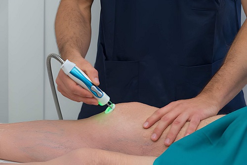 Best Non-surgical Laser Treatment for Varicose Veins in Andheri, Mumbai